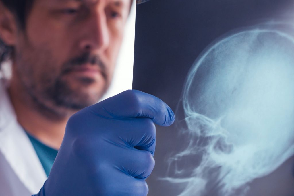 examining x-ray of skull - brain/head injury claim compensation Cardiff
